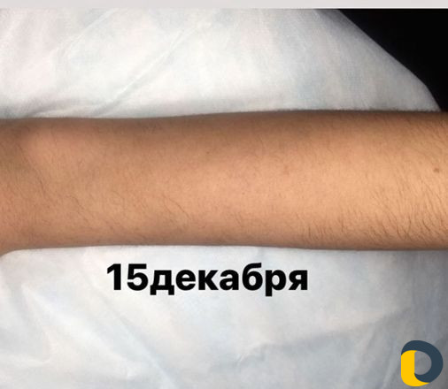 Электроэпиляция