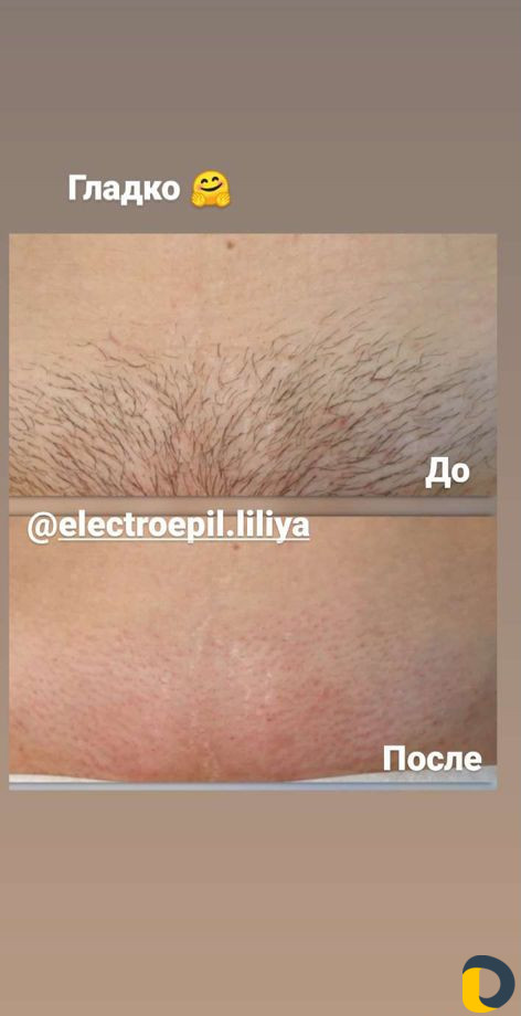 Электроэпиляция