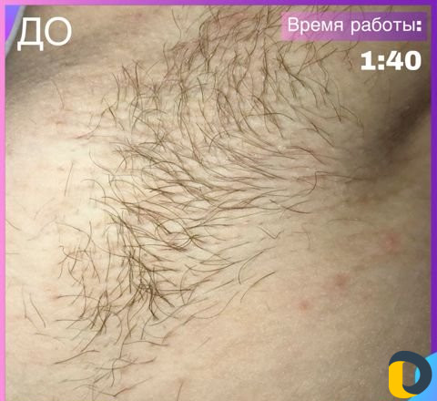 Электроэпиляция