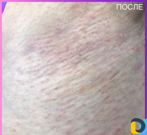 Электроэпиляция
