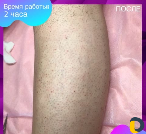 Электроэпиляция