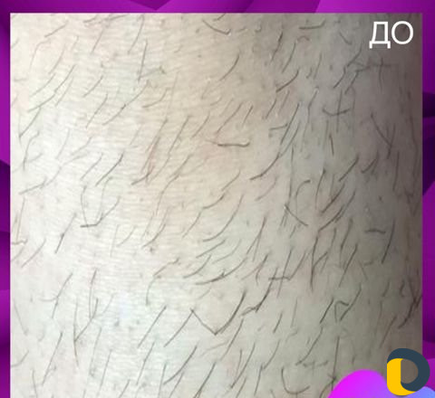 Электроэпиляция