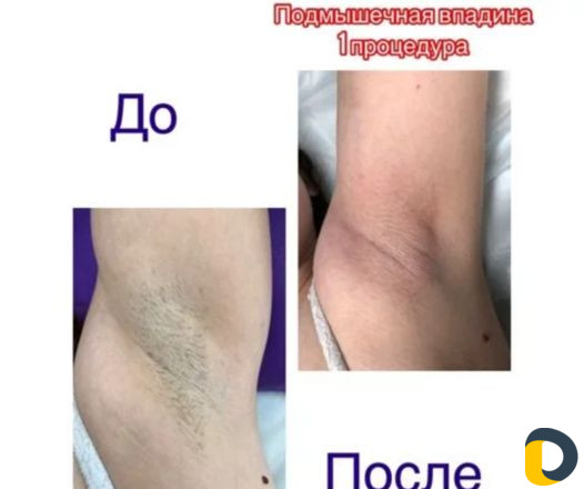 Электроэпиляция