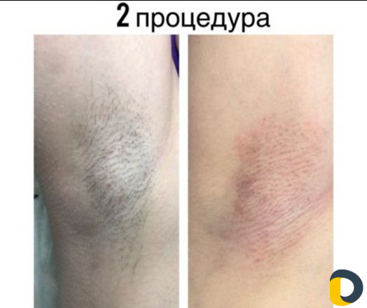 Электроэпиляция