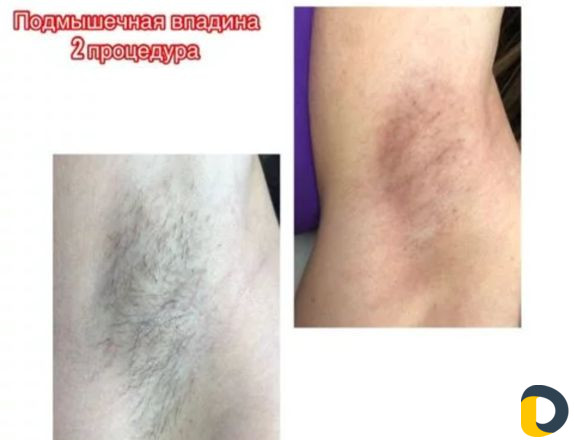 Электроэпиляция