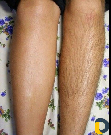 Электроэпиляция