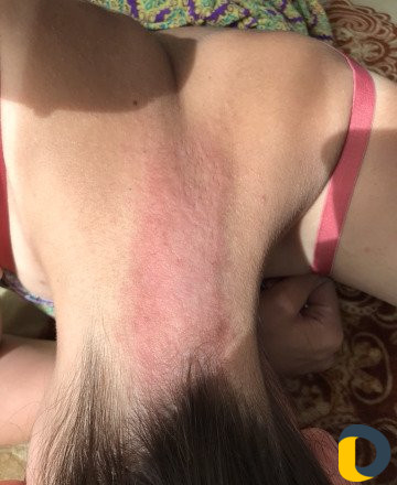 Электроэпиляция