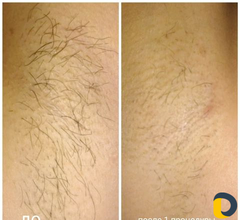 Электроэпиляция