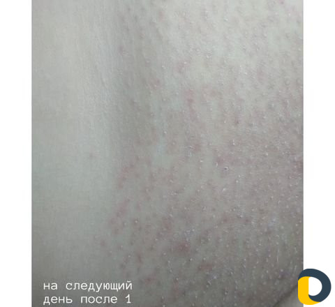 Электроэпиляция