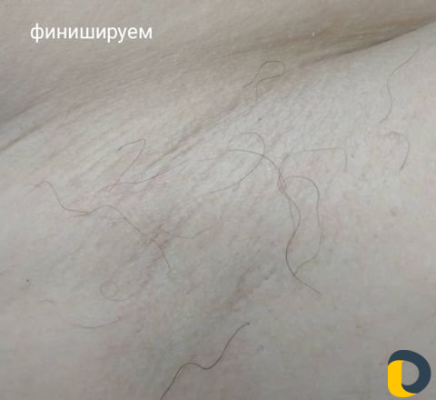 Электроэпиляция