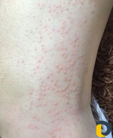 Электроэпиляция