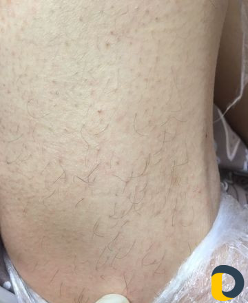 Электроэпиляция
