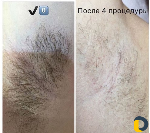 Электроэпиляция