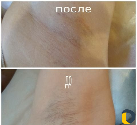 Электроэпиляция