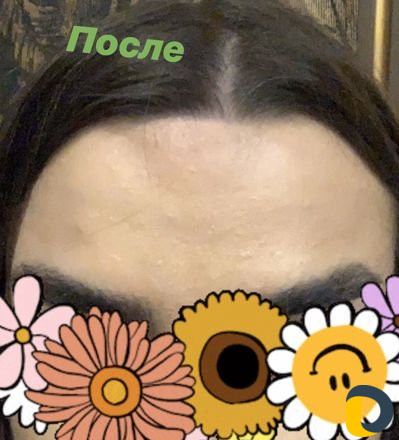 Электроэпиляция