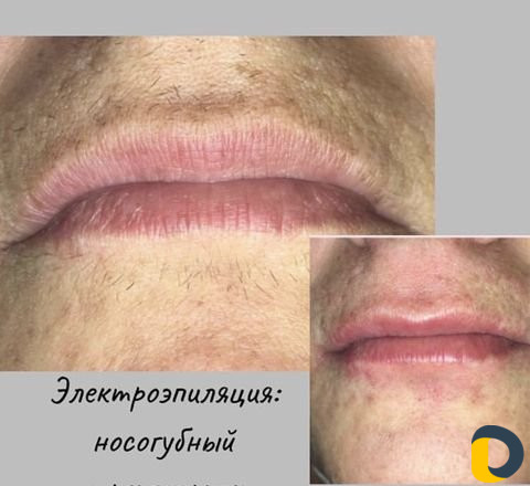 Электроэпиляция