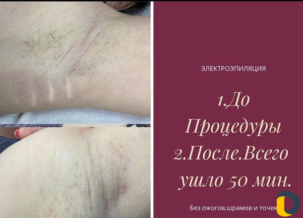 Электроэпиляция
