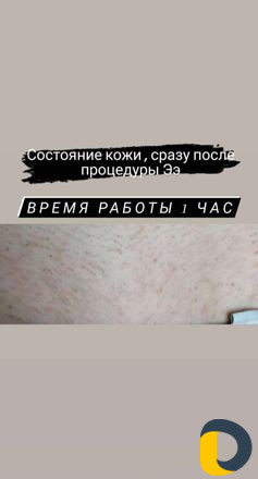 Электроэпиляция