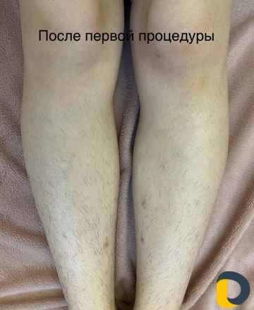 Электроэпиляция