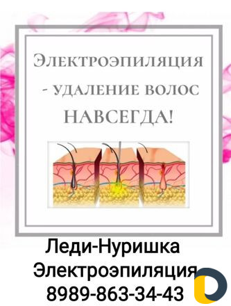 Электроэпиляция