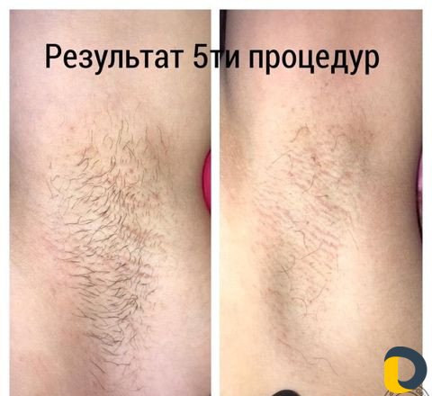 Электроэпиляция