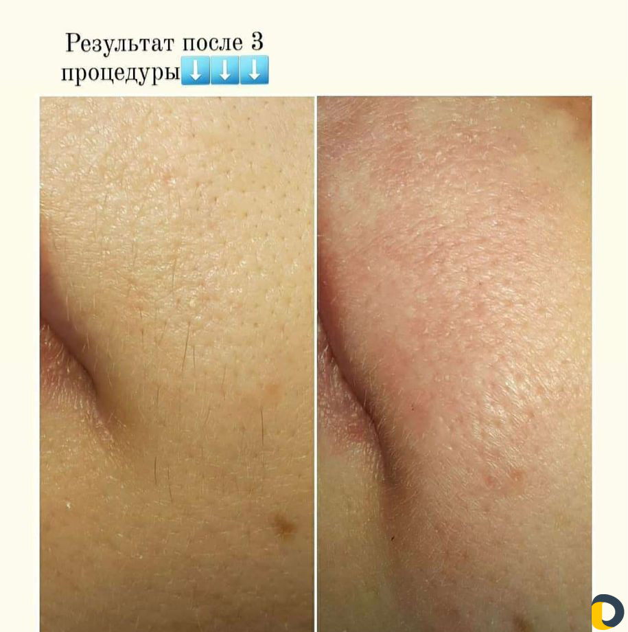 Электроэпиляция