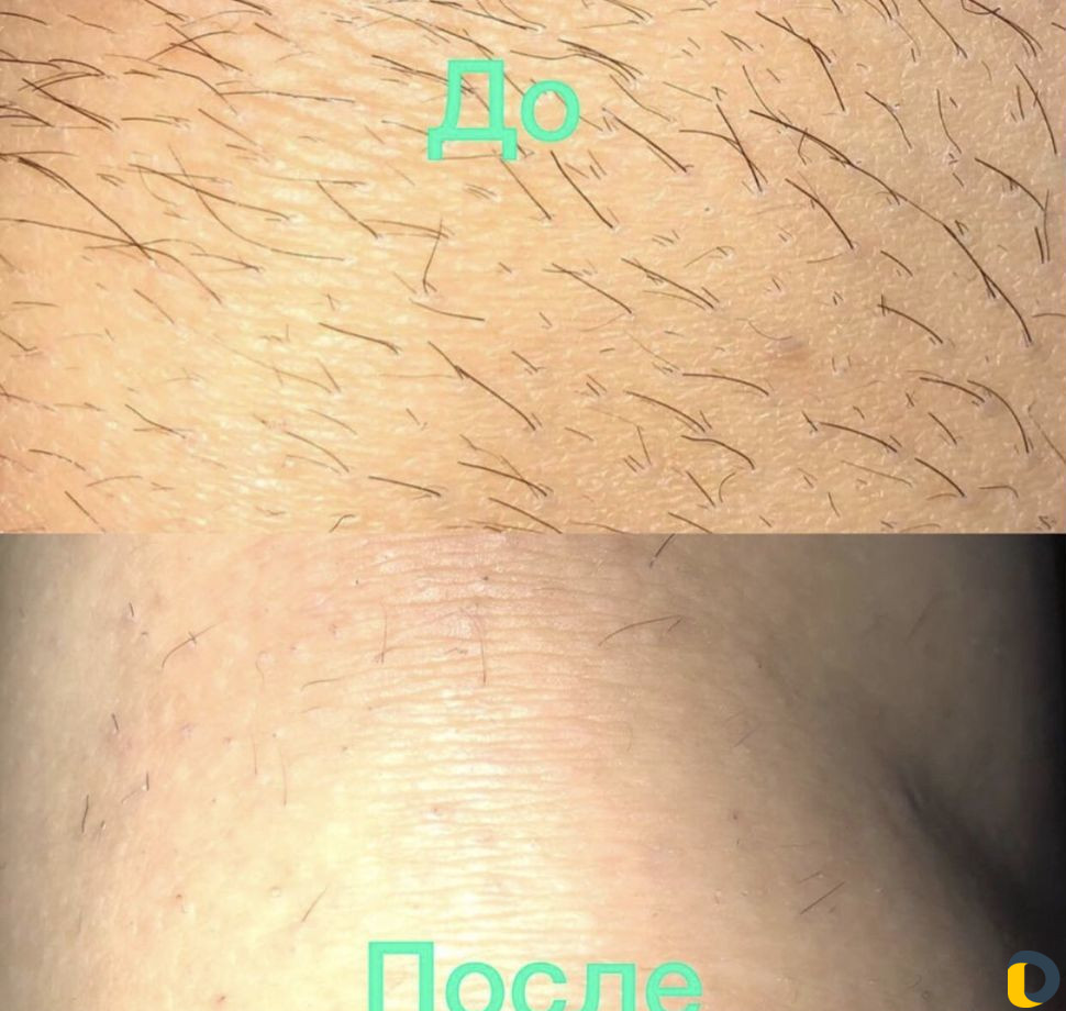 Электроэпиляция