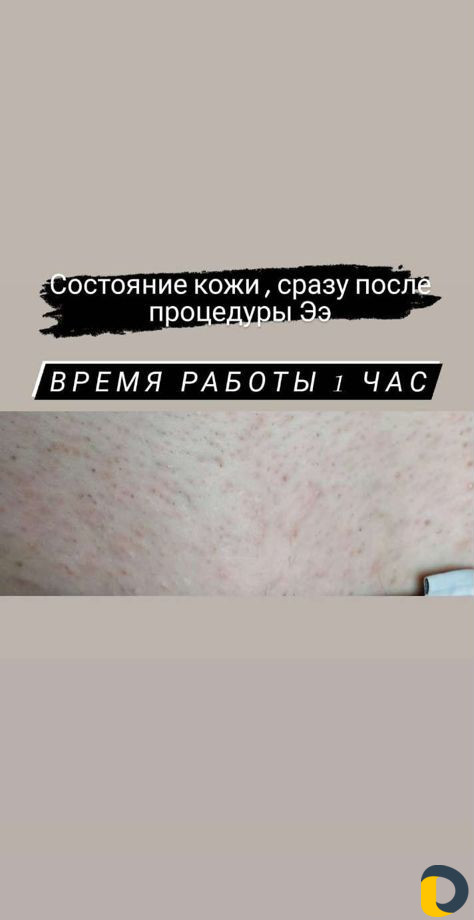 Электроэпиляция