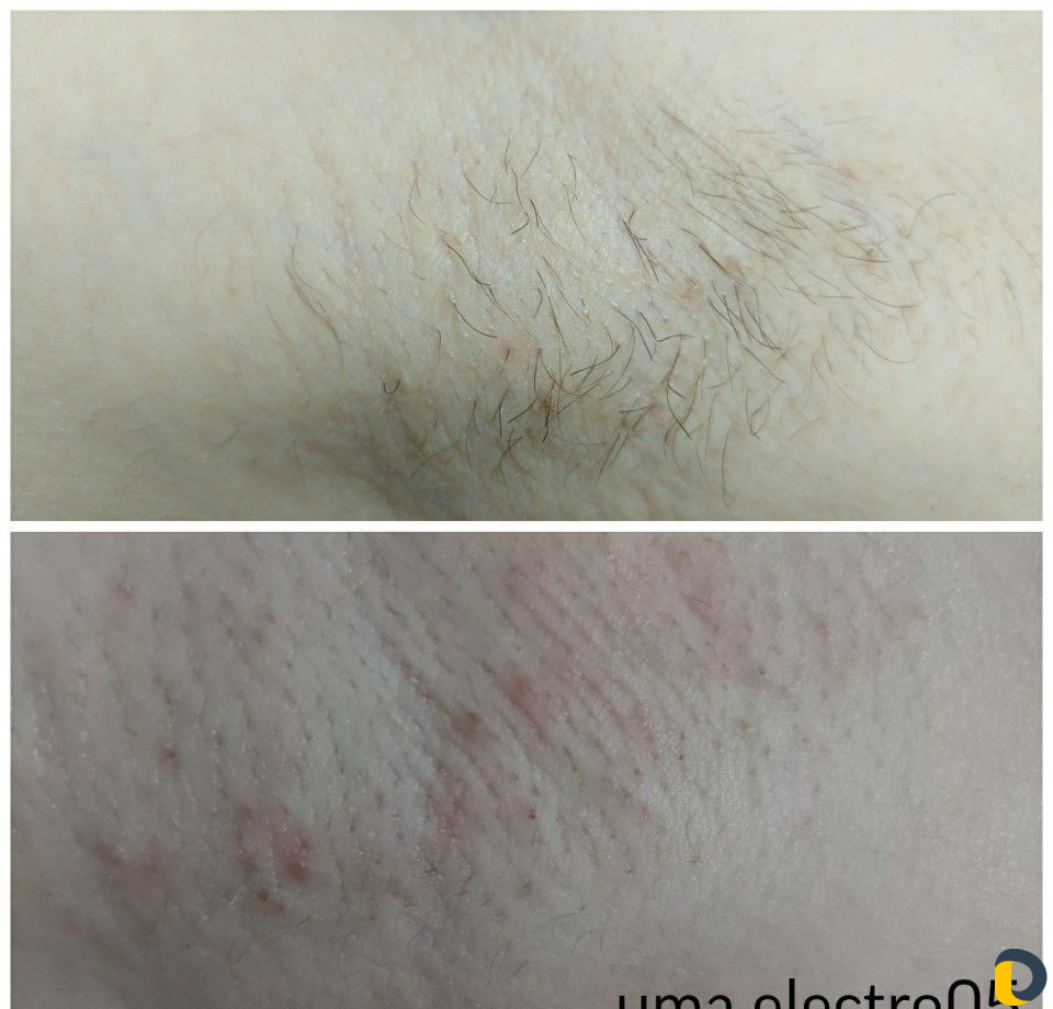 Электроэпиляция