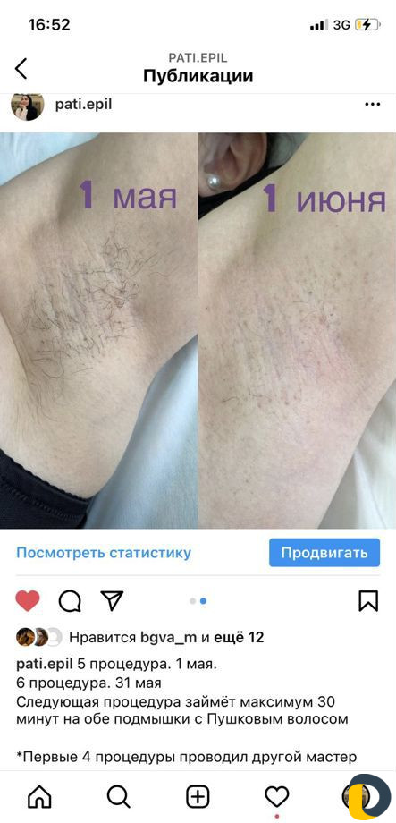 Электроэпиляция