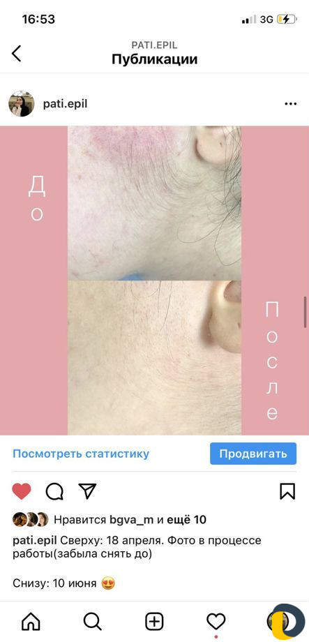 Электроэпиляция