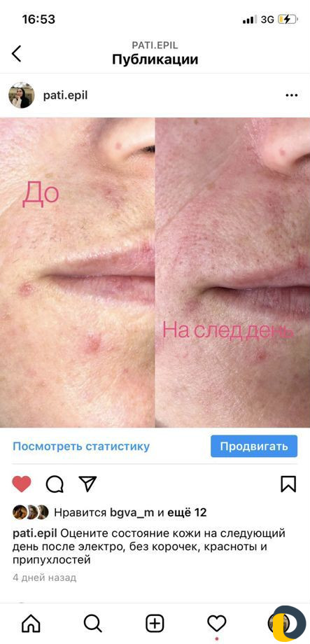 Электроэпиляция