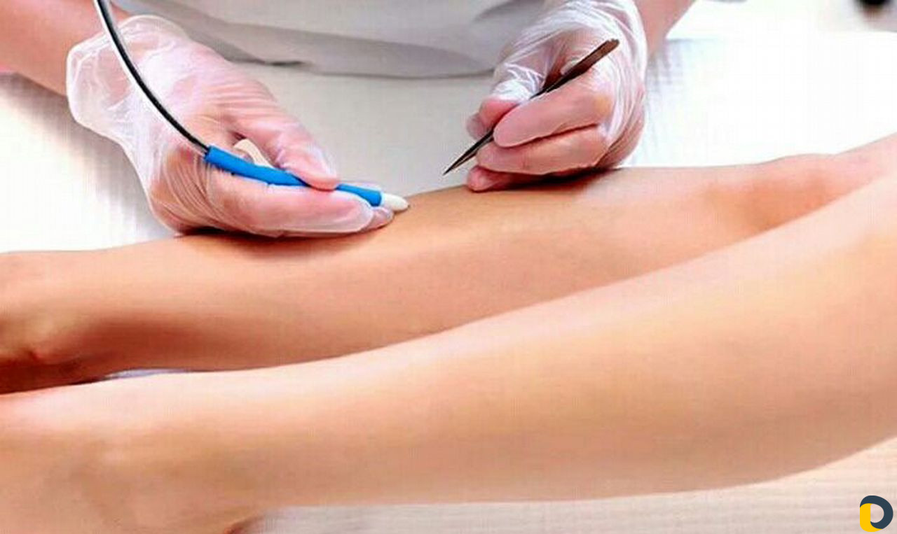 Электроэпиляция