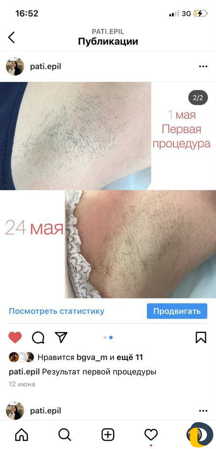 Электроэпиляция