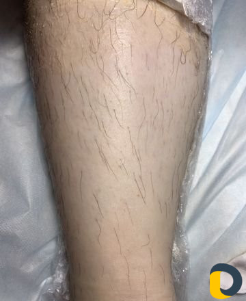 Электроэпиляция