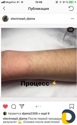 Электроэпиляция