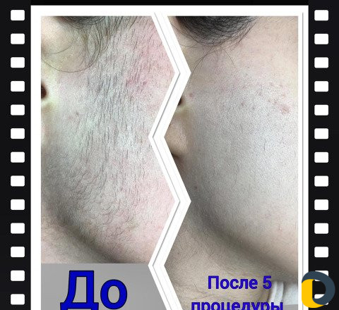 Электроэпиляция