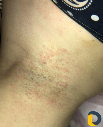 Электроэпиляция