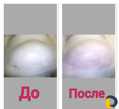 Электроэпиляция