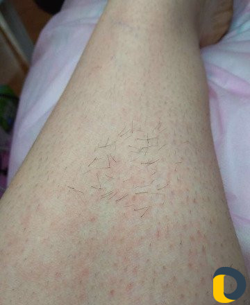 Электроэпиляция/Воск