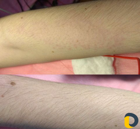 Электроэпиляция/Воск