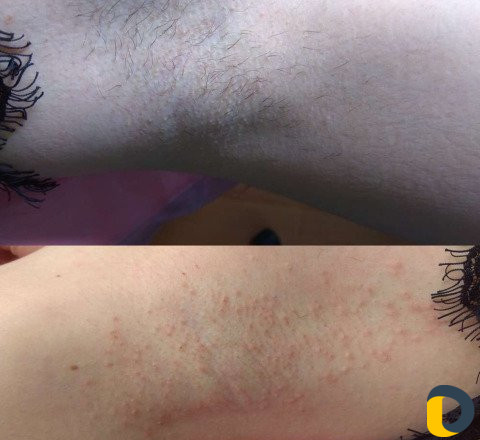 Электроэпиляция/Воск