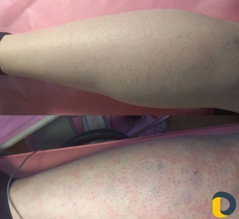 Электроэпиляция/Воск