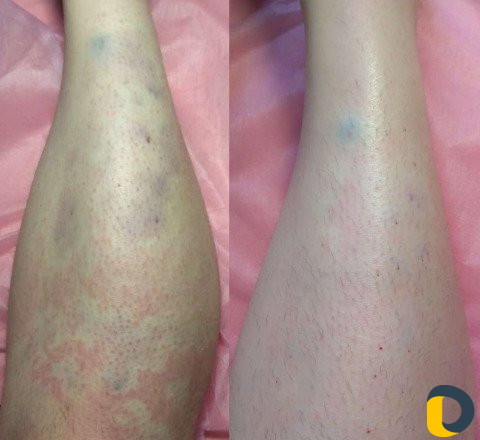 Электроэпиляция/Воск