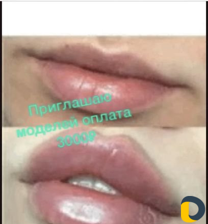 Эпиляция шугаринг косметология