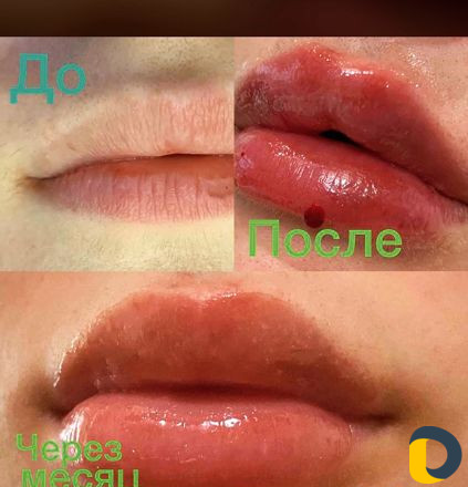 Эпиляция шугаринг косметология