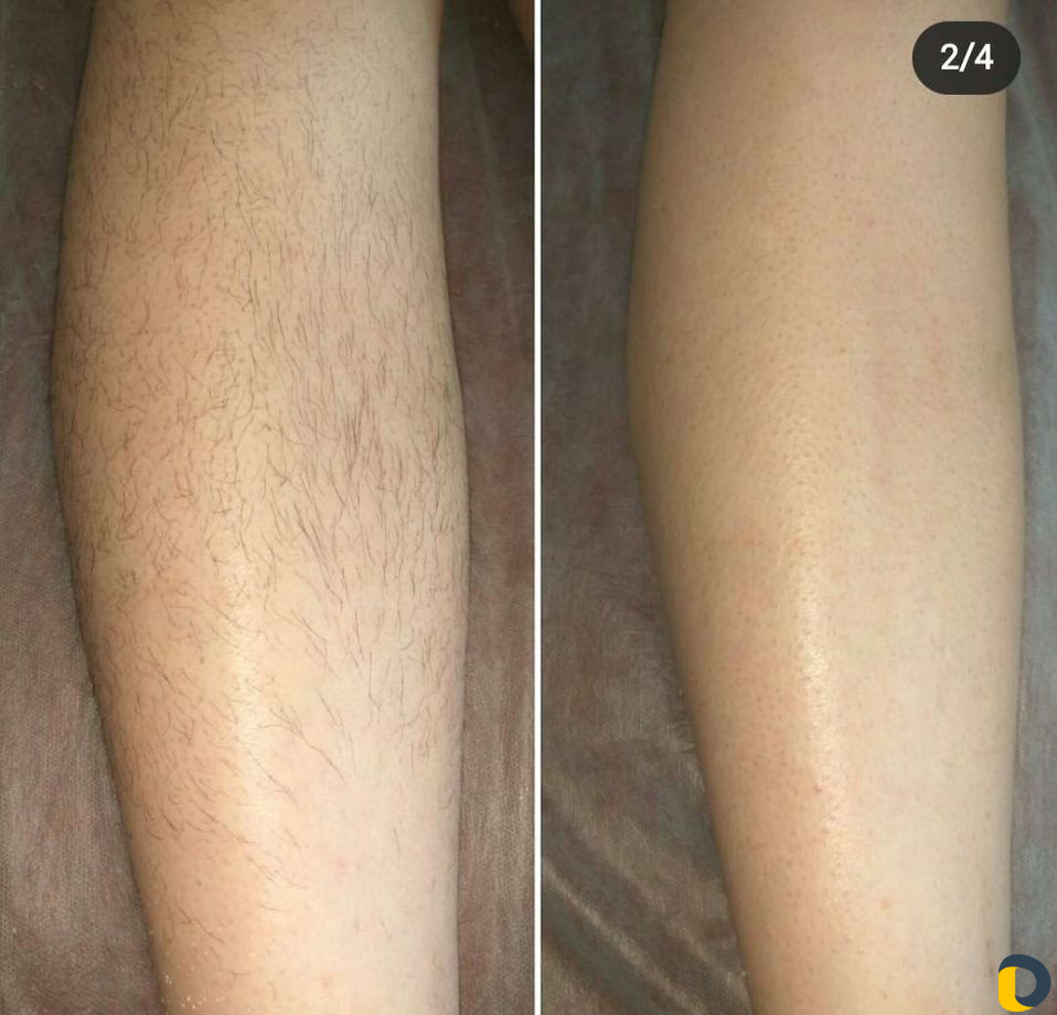 Эпиляция шугаринг