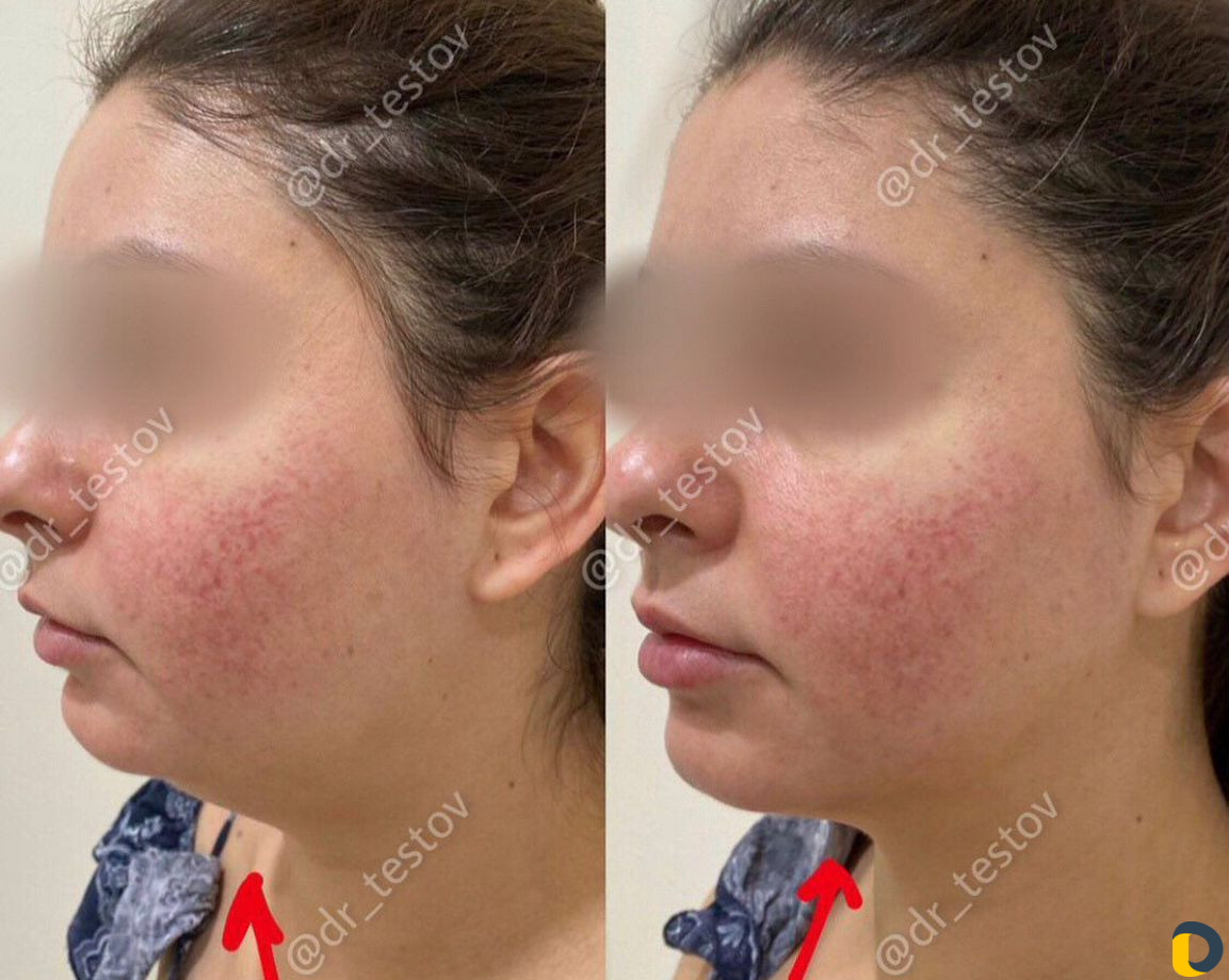 Фейслифтинг