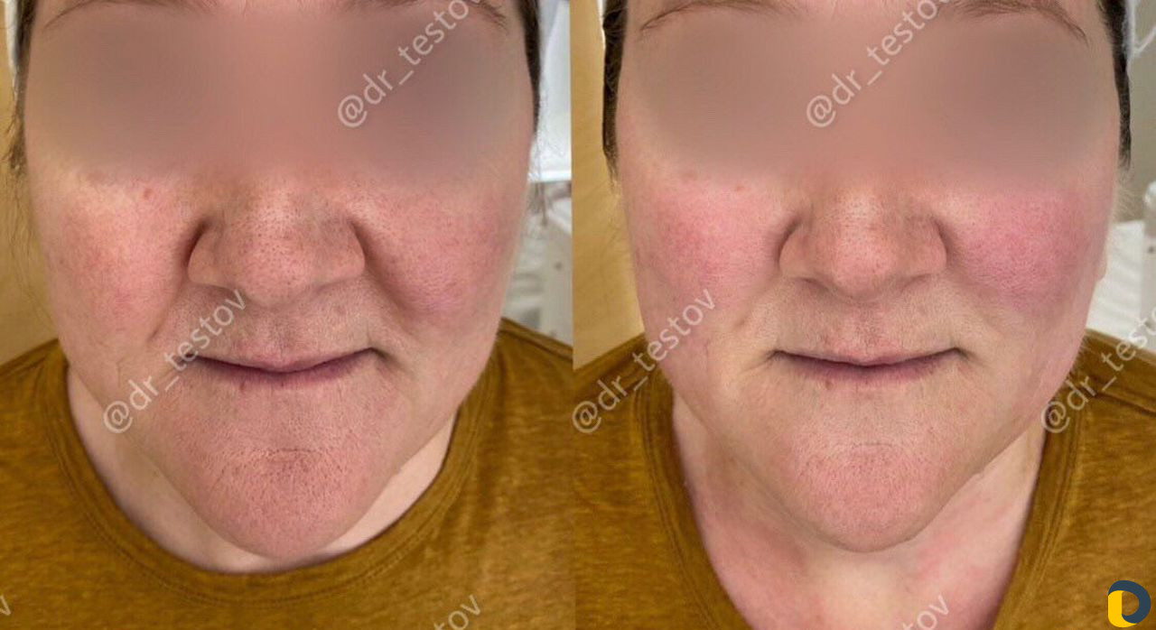 Фейслифтинг