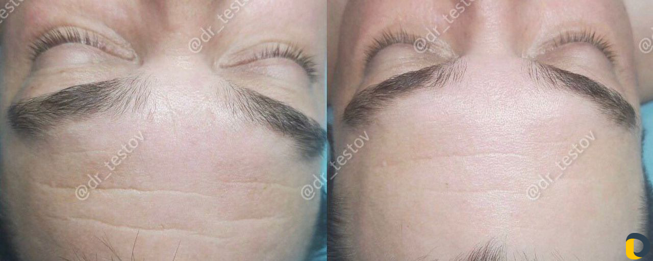 Фейслифтинг